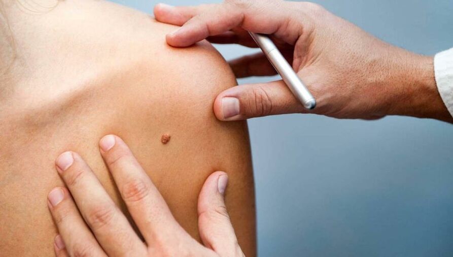 Dermatologas apžiūri papiloma sergantį pacientą