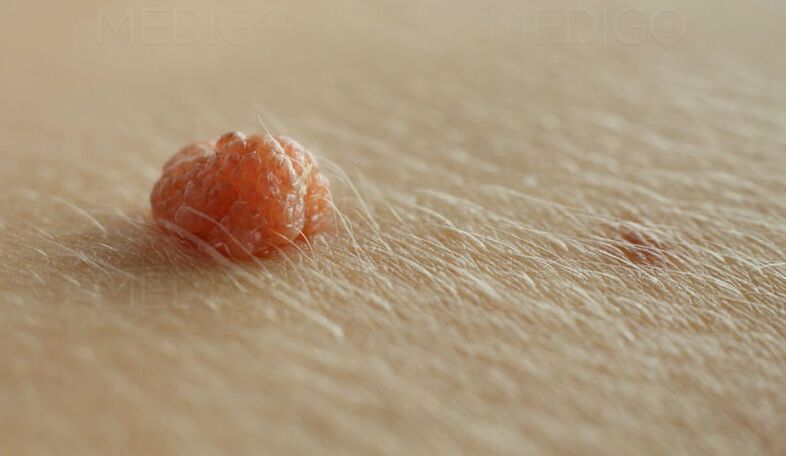 papiloma ant odos