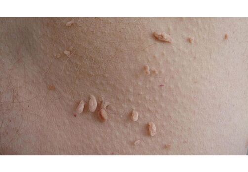 ŽPV infekcijos požymis yra papilomų atsiradimas ant kūno